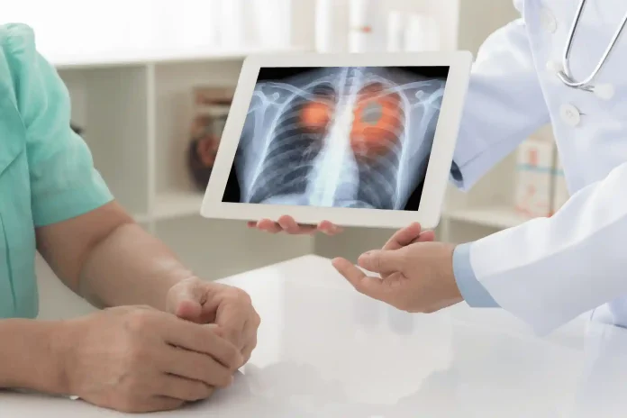 radiation treatment for lung cancer